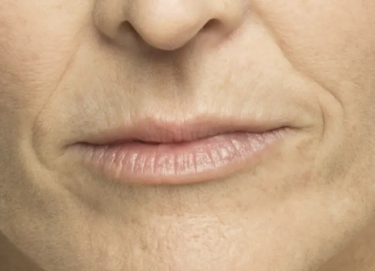 Before results with Belotero Balance (+) for nasolabial folds